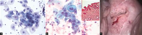 mild inflammation on pap smear|partially obscuring inflammation on pap.